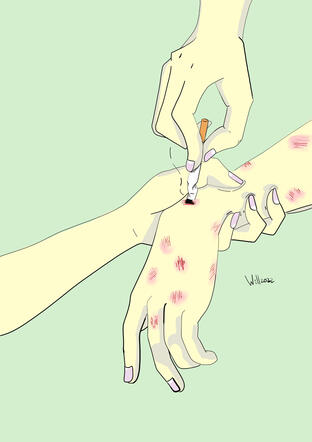 Mano quemada a digital